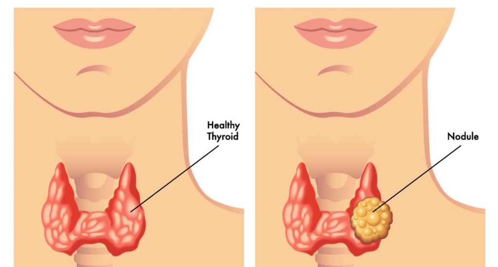 tiroid nodul