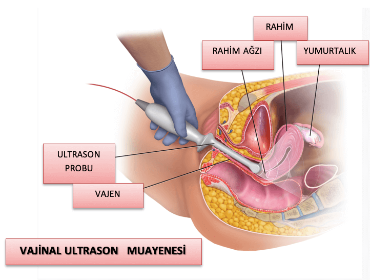 transvajinal ultrasonografi muayenesi