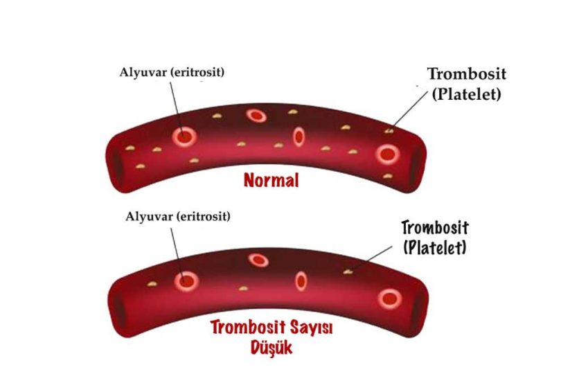 trombosit düşüklüğü